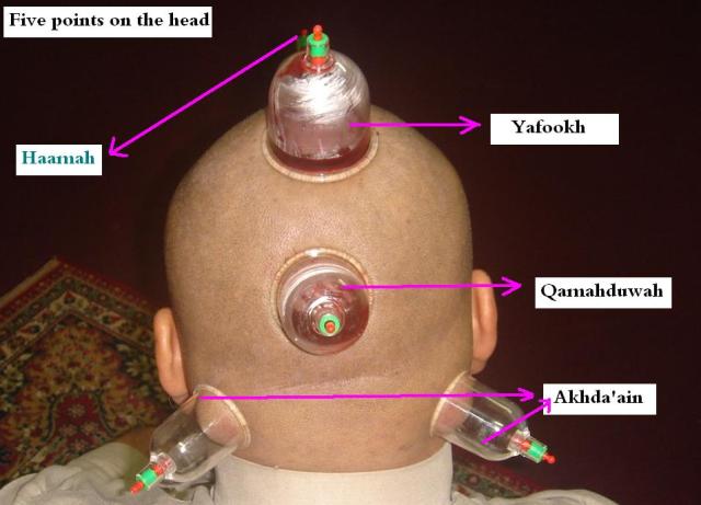 Hijamah as 5 points on the head